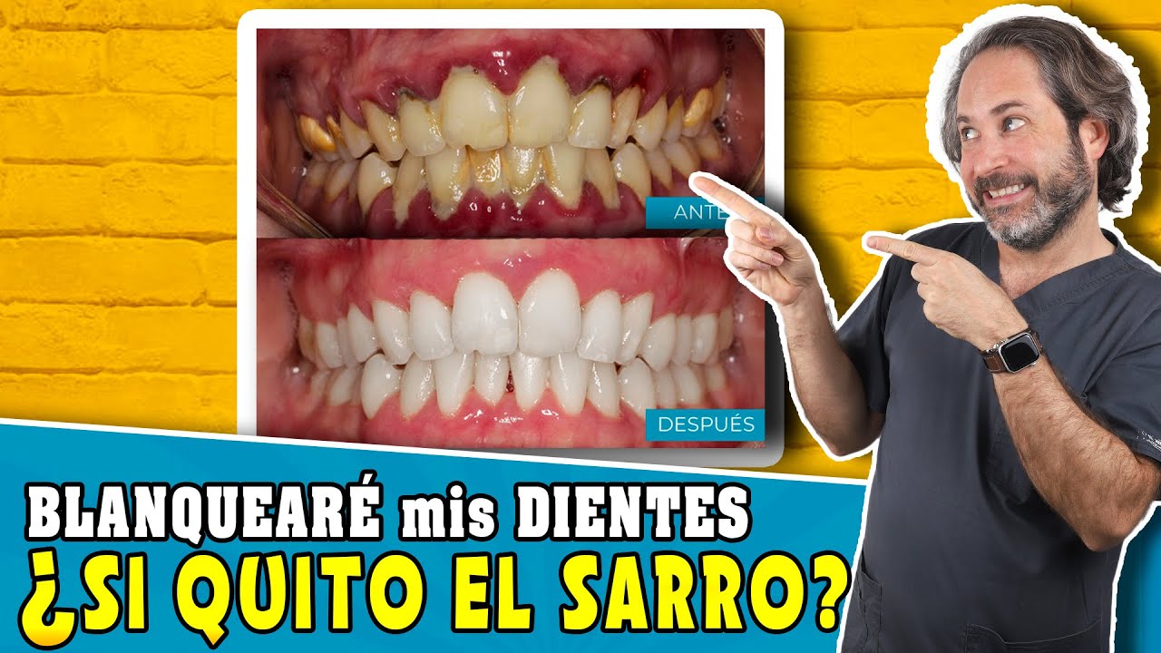 limpiezas dentales antes y despues