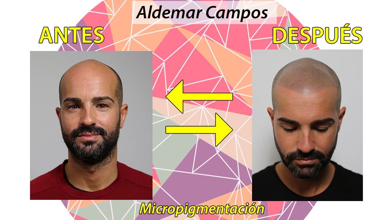 micropigmentación capilar antes y después